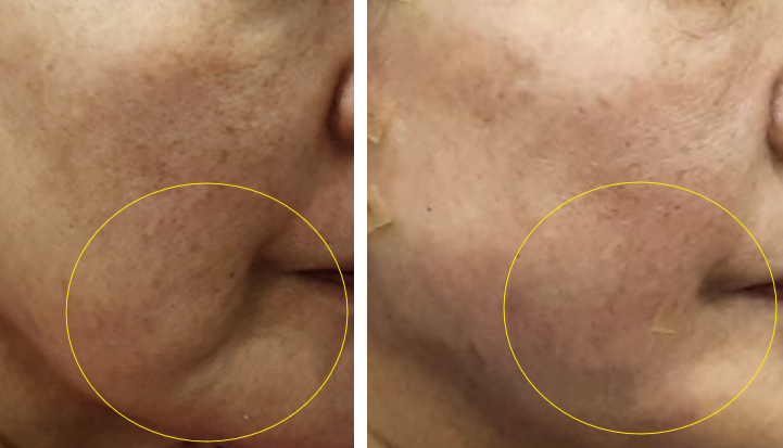shinederma clinic 案例