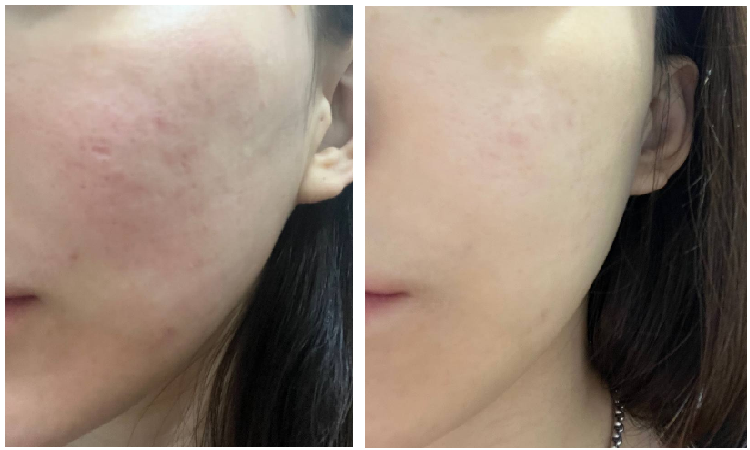 shinederma clinic 案例