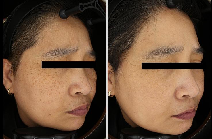 shinederma clinic 案例