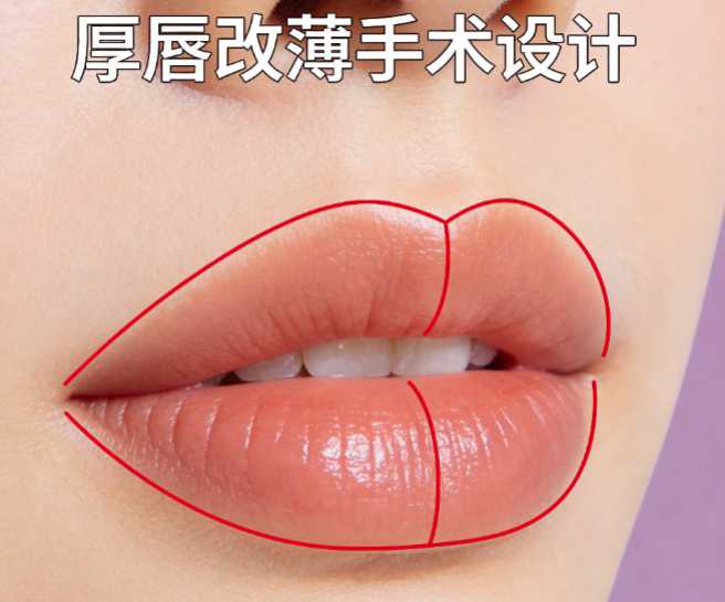 厚唇组织切除术