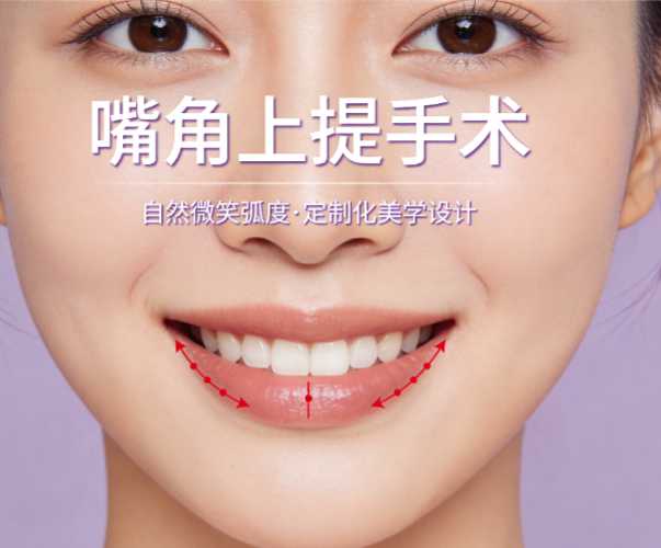 嘴角上提术