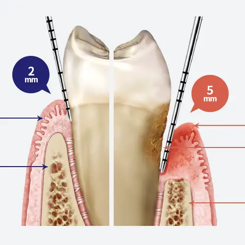 Periodontal treatment