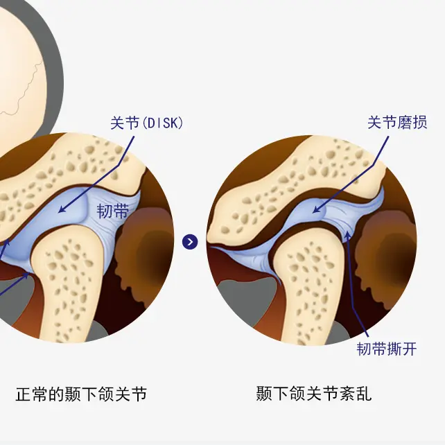 Teeth grinding/jaw temporomandibular joint treatment
