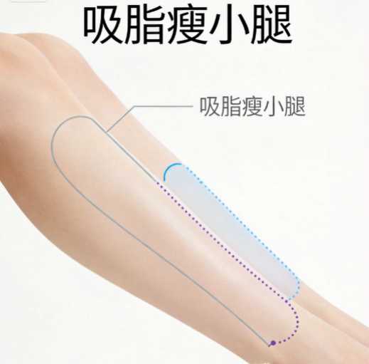 吸脂瘦小腿