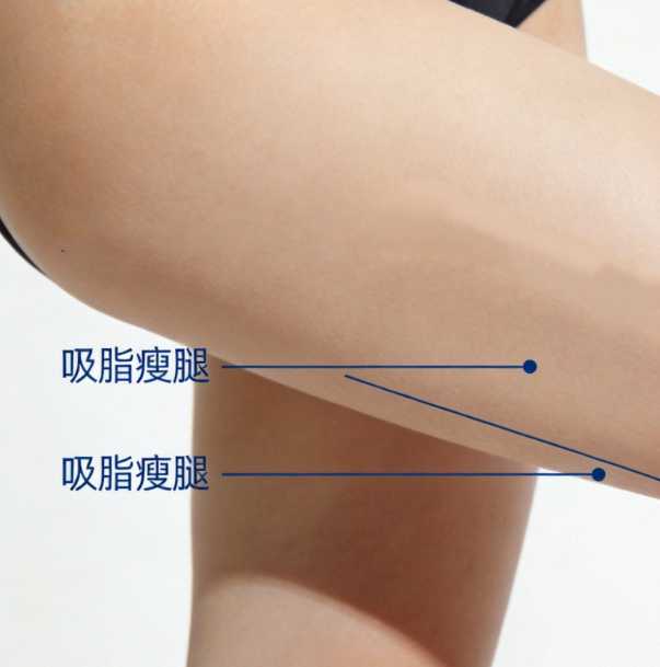 大腿环吸+膝内侧塑形+小腿+假胯塑形