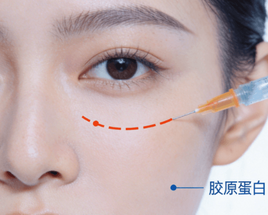 面部除皱提升