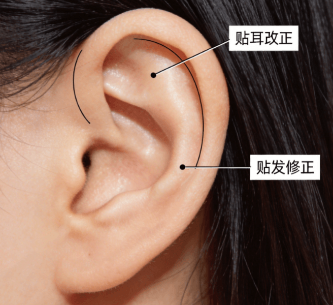 贴发耳矫正
