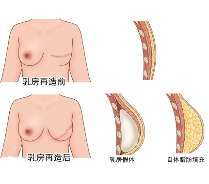 腹部组织乳房重建