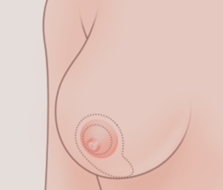 乳房缩小
