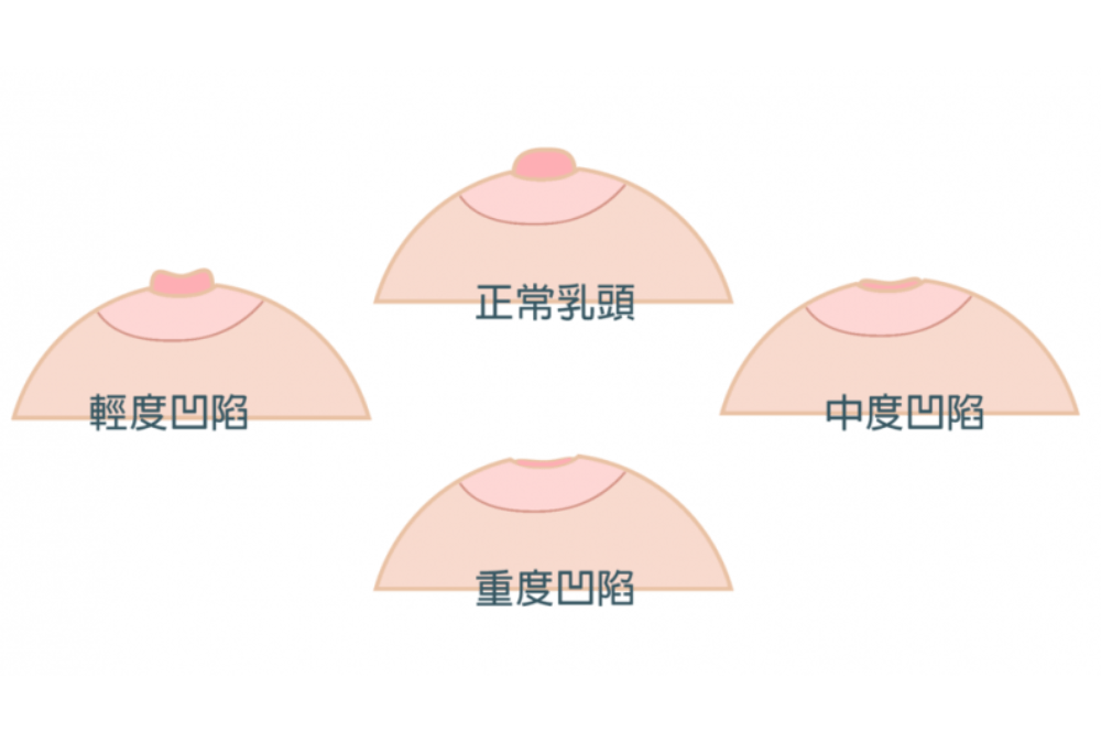 乳头凹陷矫正