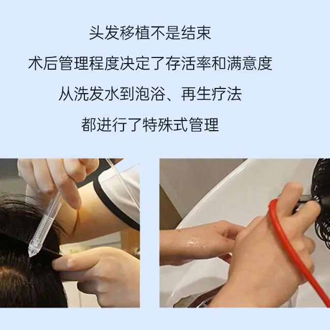 毛家毛发移植医院