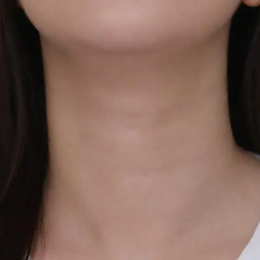 Hyaluronic acid filling for neck wrinkles