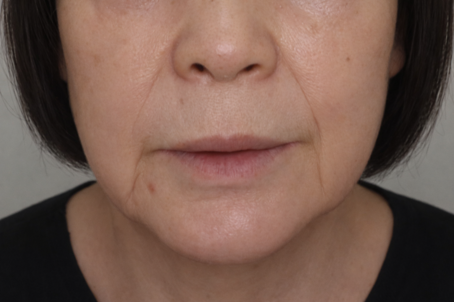 Allure Plastic Surgery 案例