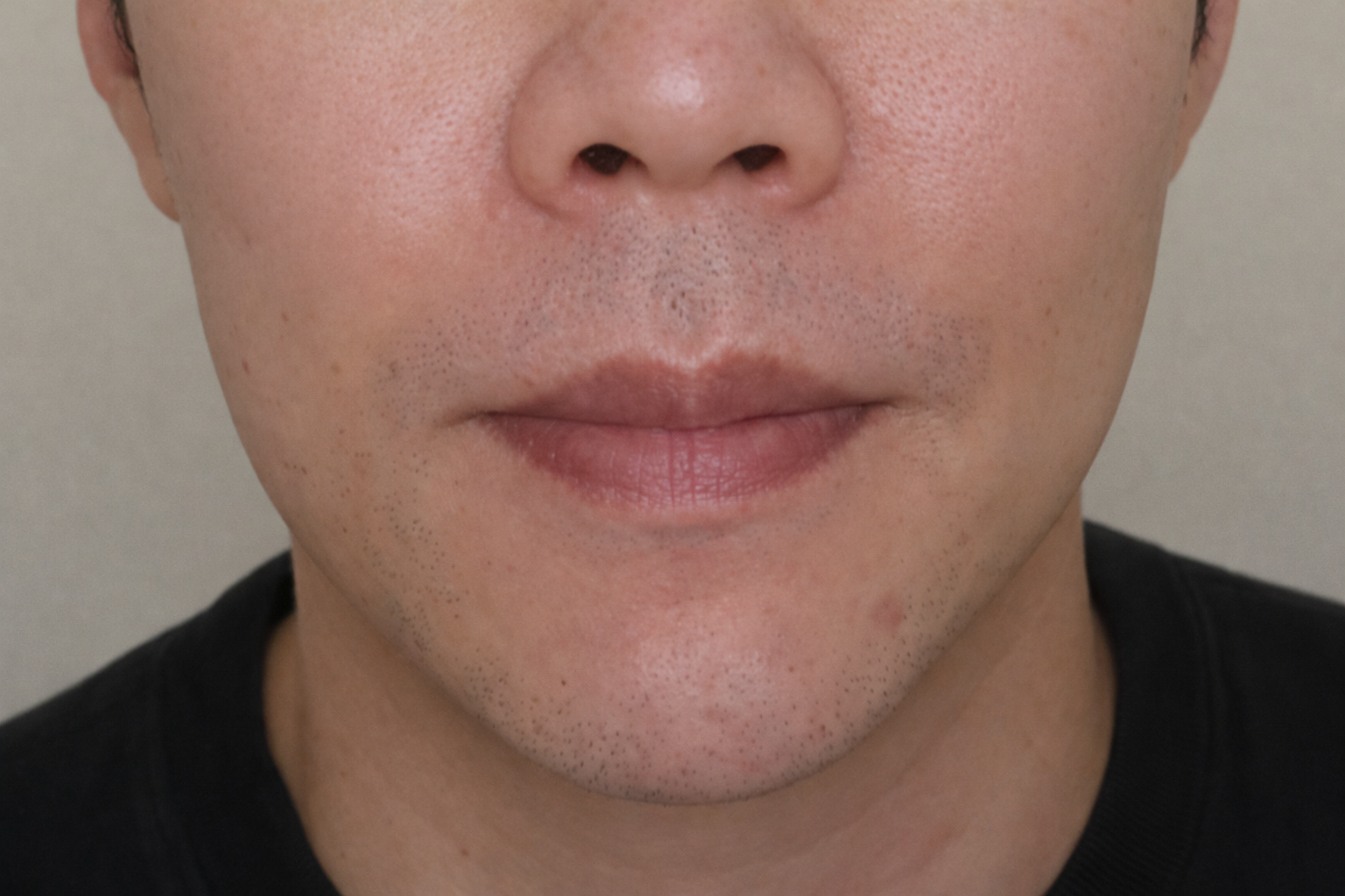 Allure Plastic Surgery 案例