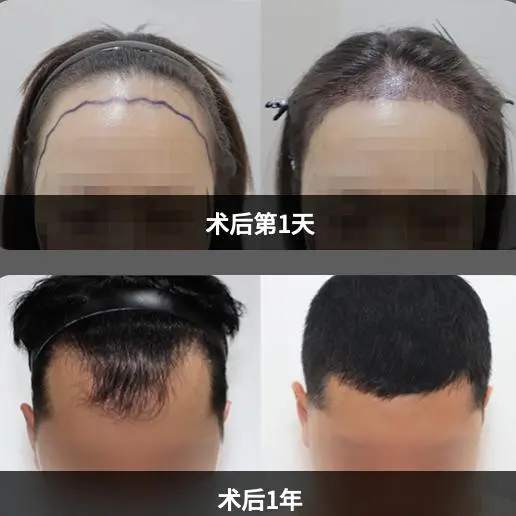 Female Hairline Correction