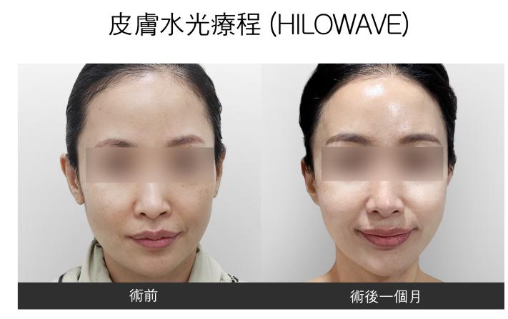 renovo 案例