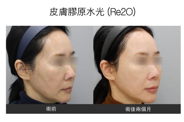 renovo 案例