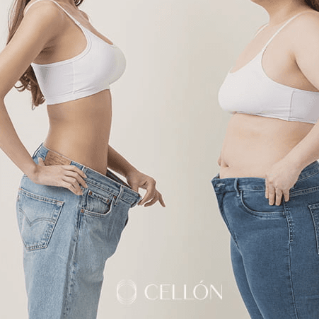 VShape liposuction