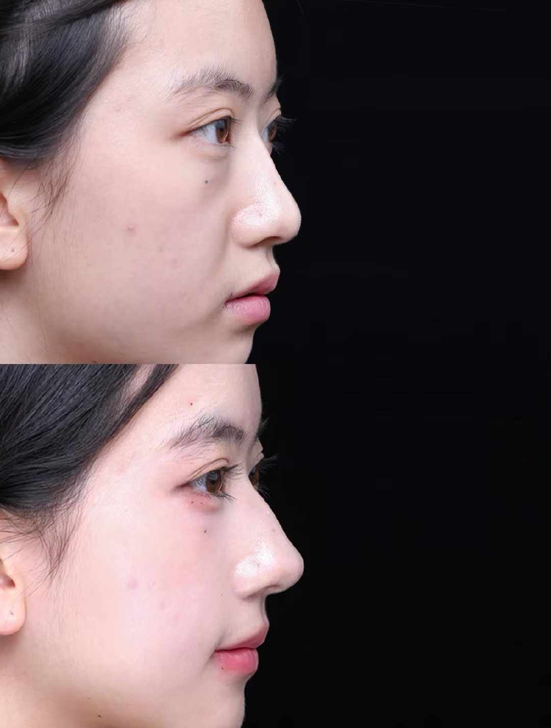 打完玻尿酸后，为什么她看起来像“偷偷变漂亮了”？