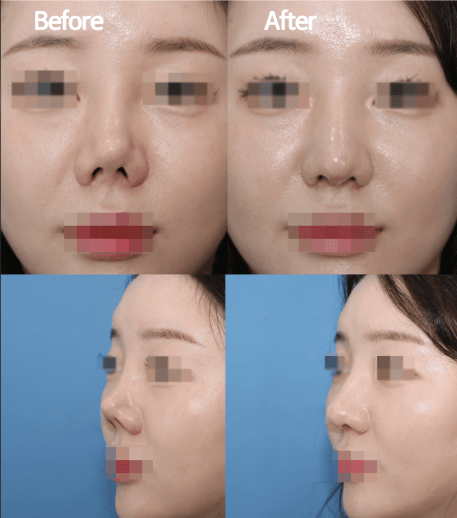 MIJAK RHINOPLASTY   & AESTHETIC CLINIC 案例