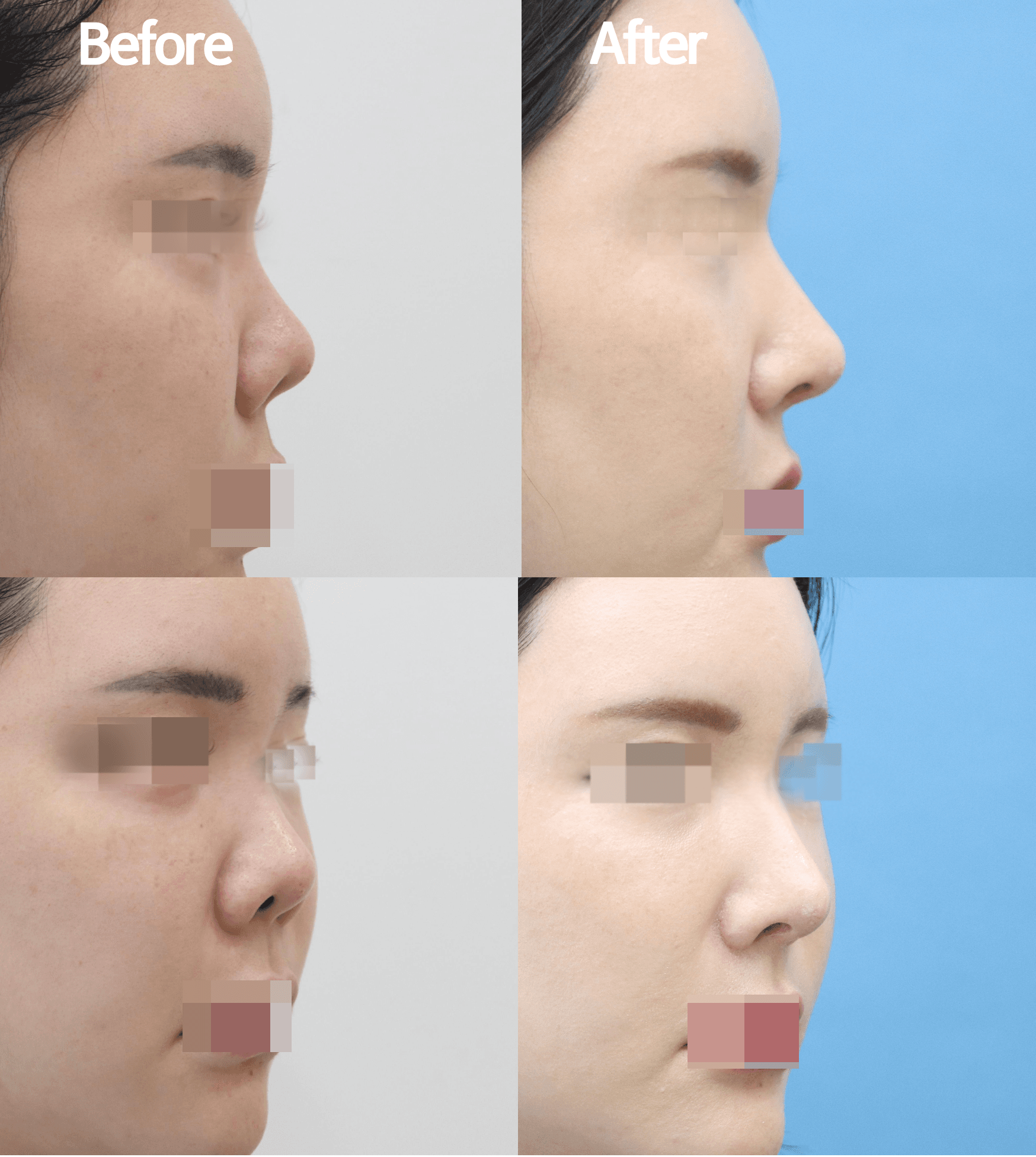 MIJAK RHINOPLASTY   & AESTHETIC CLINIC 案例