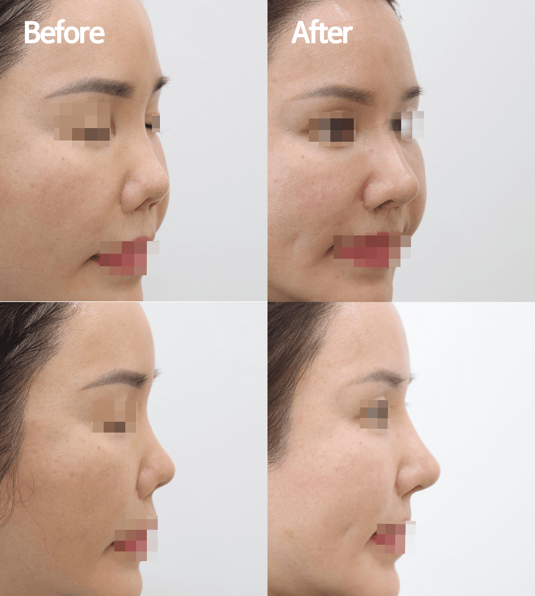 MIJAK RHINOPLASTY   & AESTHETIC CLINIC 案例