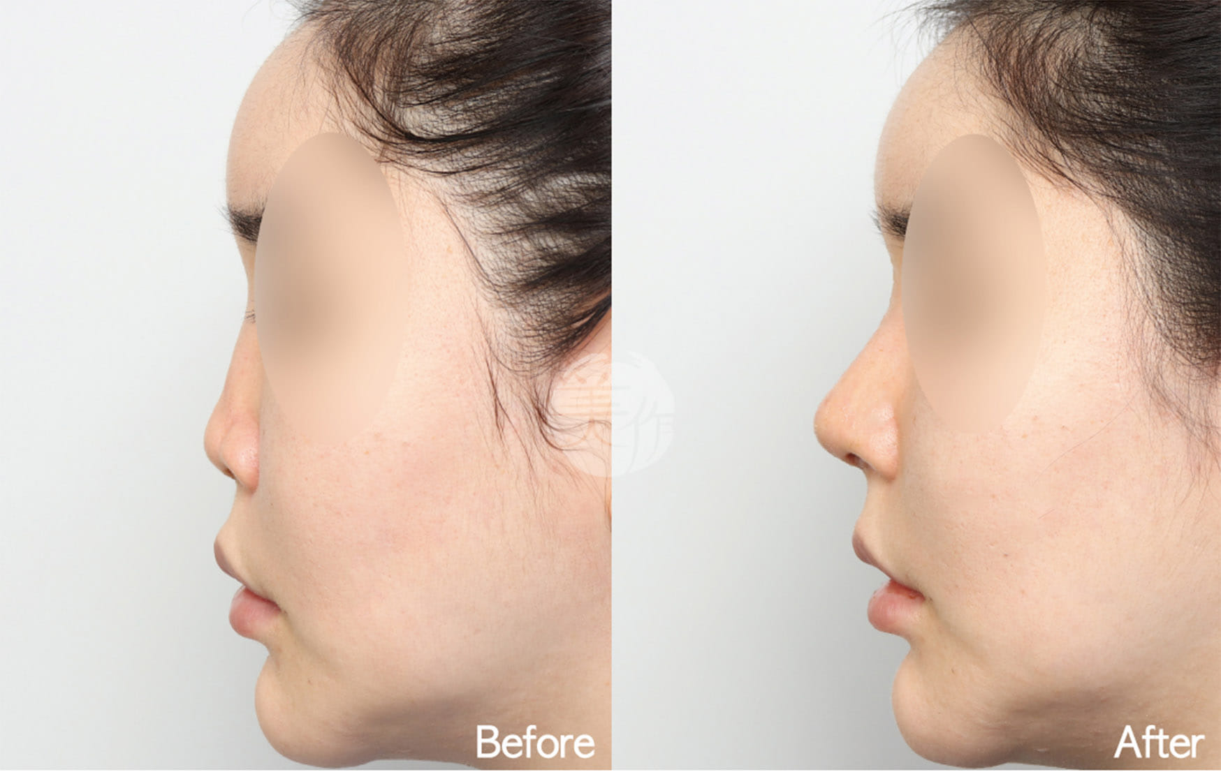 MIJAK RHINOPLASTY   & AESTHETIC CLINIC 案例