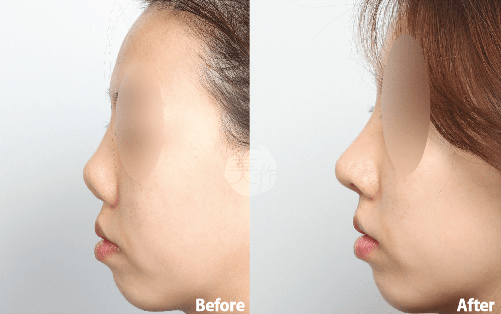 MIJAK RHINOPLASTY   & AESTHETIC CLINIC 案例