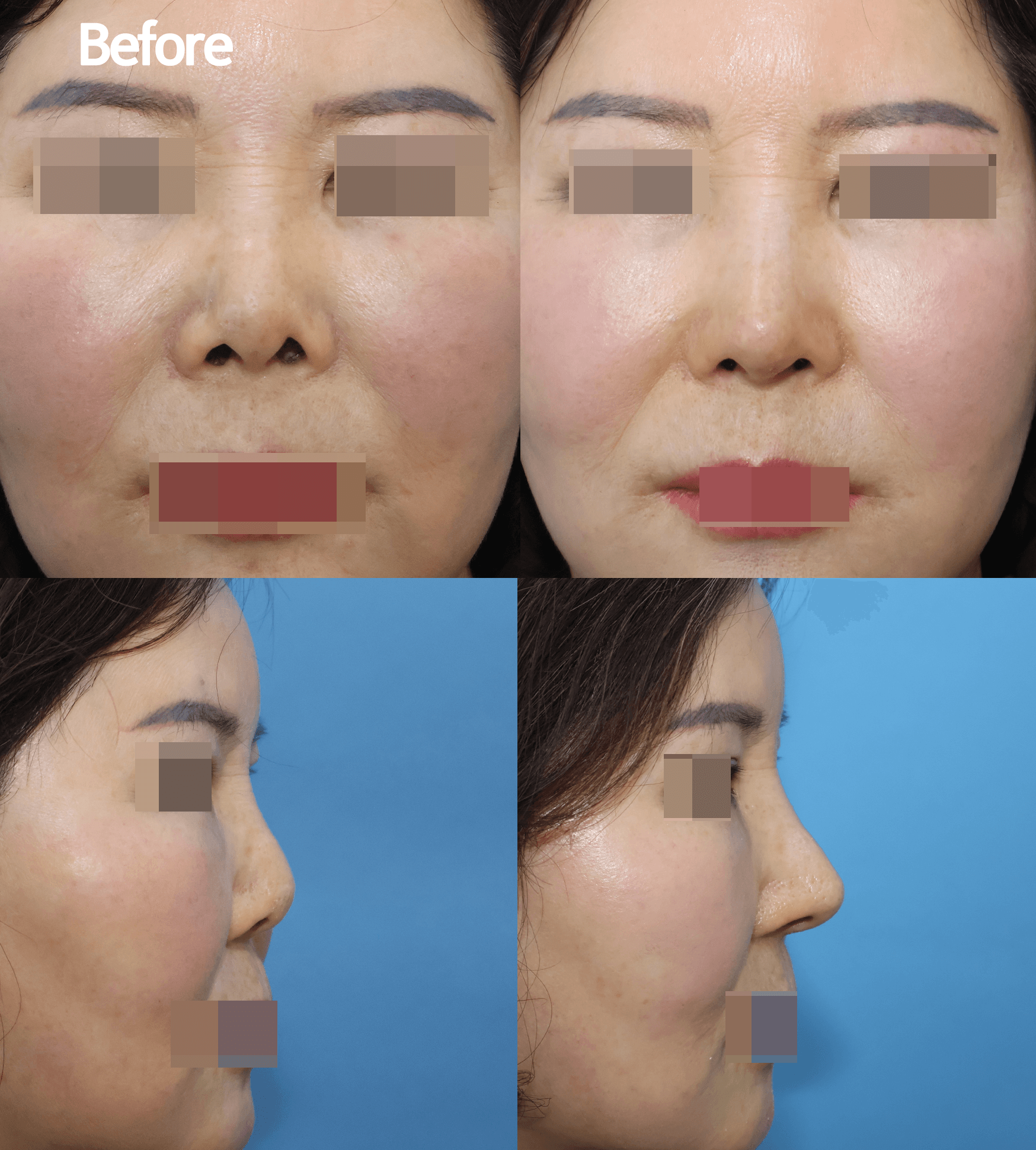 MIJAK RHINOPLASTY   & AESTHETIC CLINIC 案例