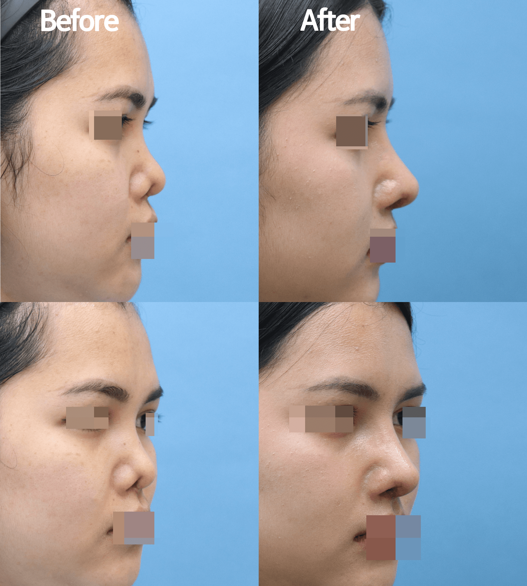 MIJAK RHINOPLASTY   & AESTHETIC CLINIC 案例