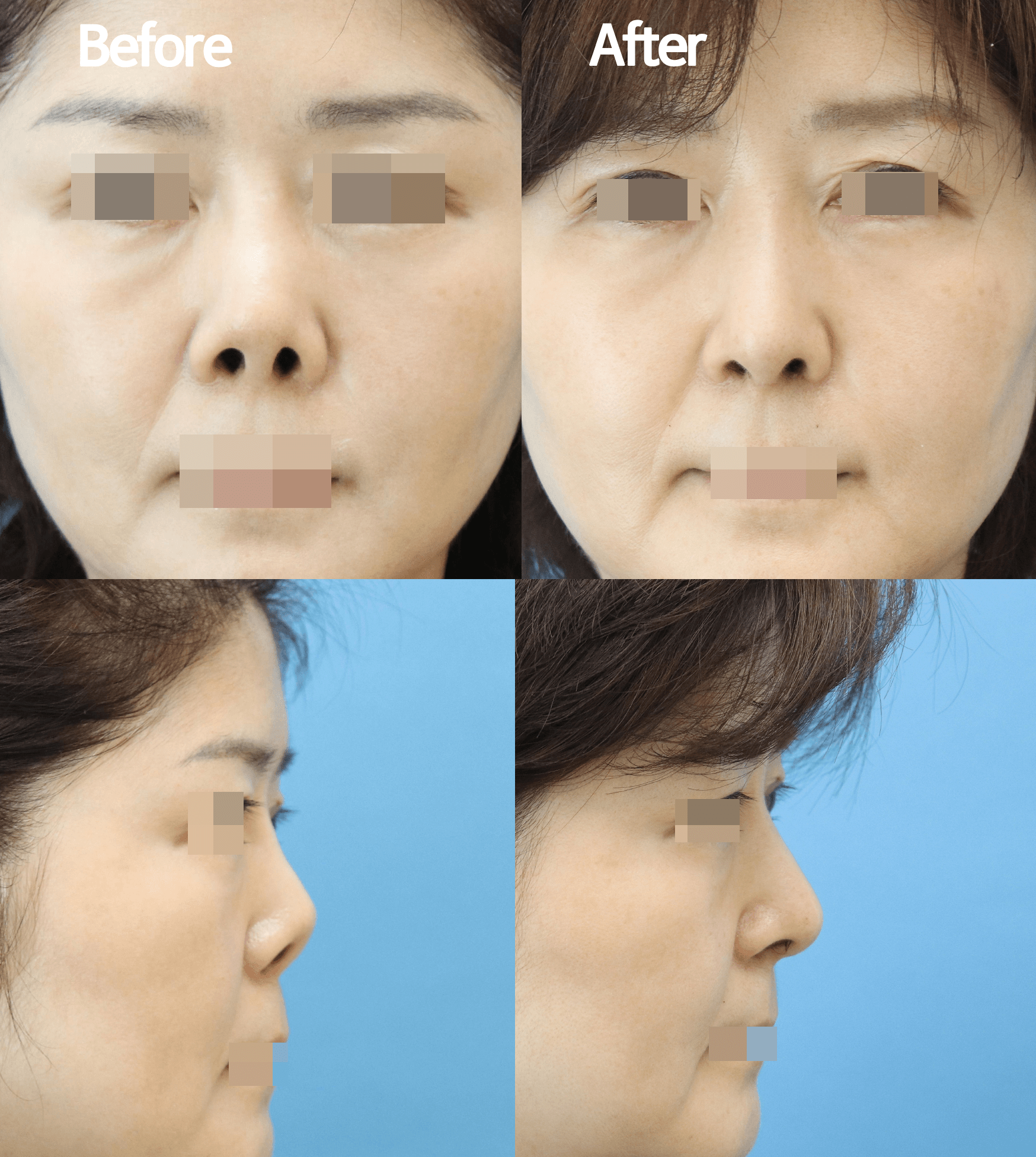MIJAK RHINOPLASTY   & AESTHETIC CLINIC 案例