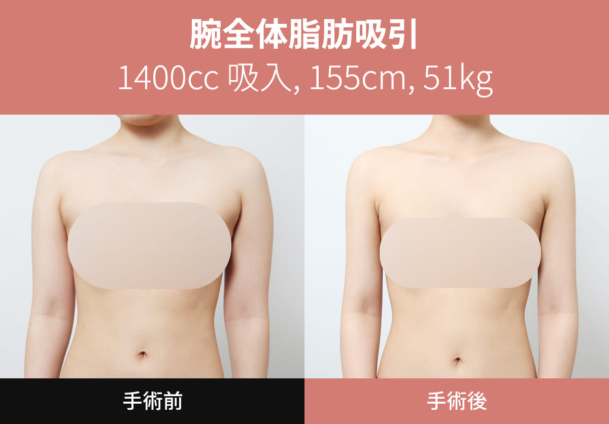 N-slim吸脂医院 案例