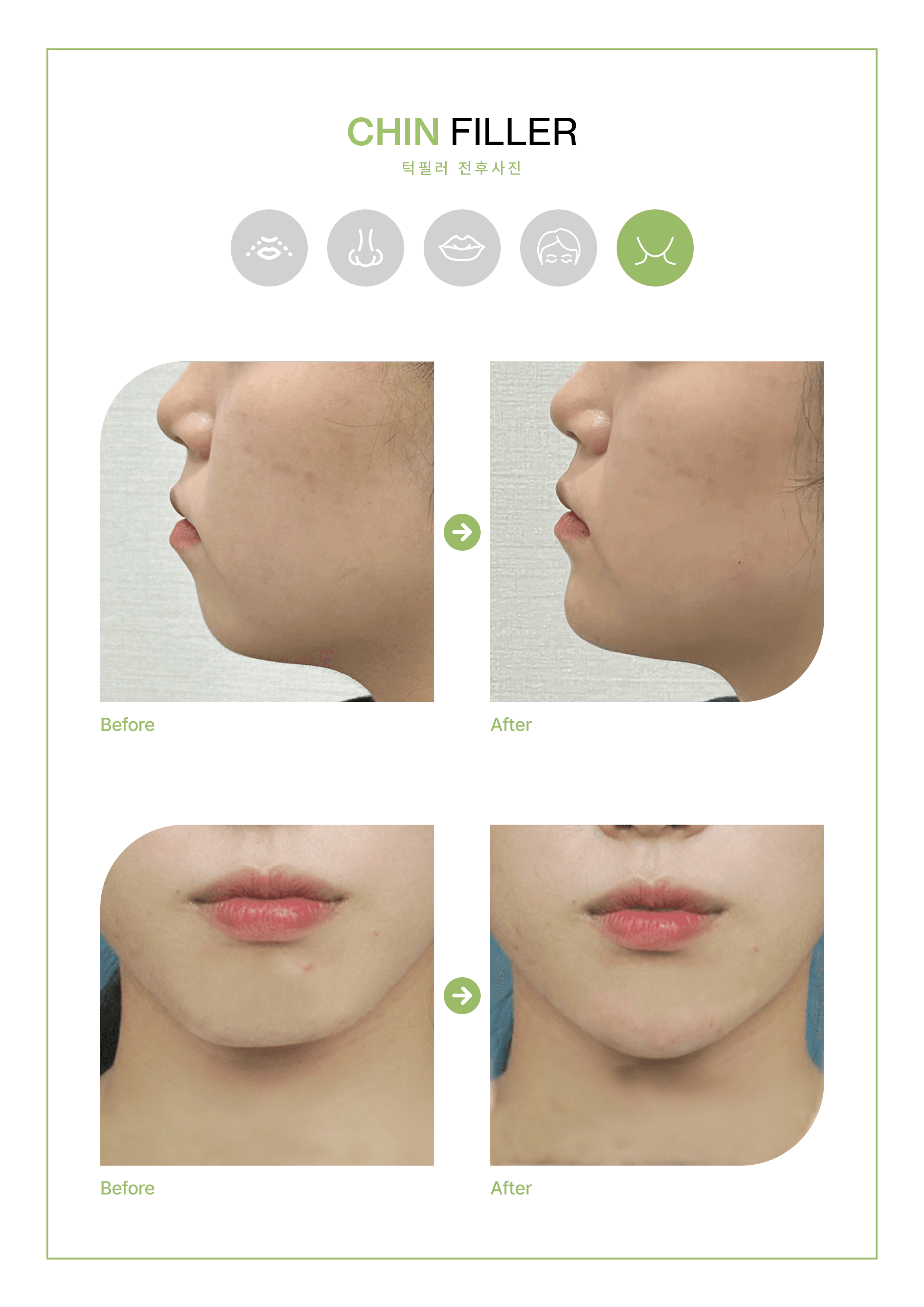VSLINE CLINIC GANGNAM 案例