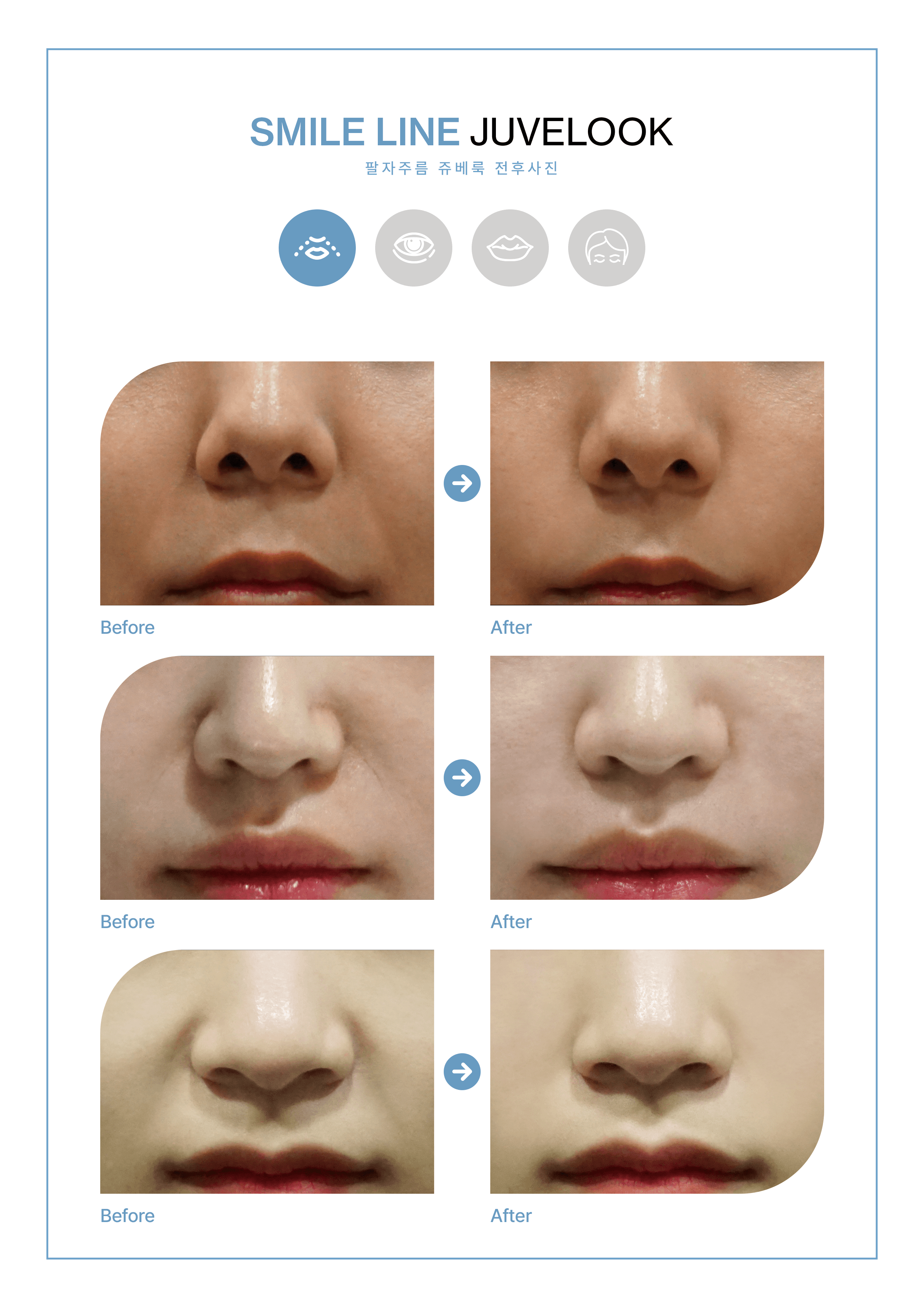 VSLINE CLINIC GANGNAM 案例