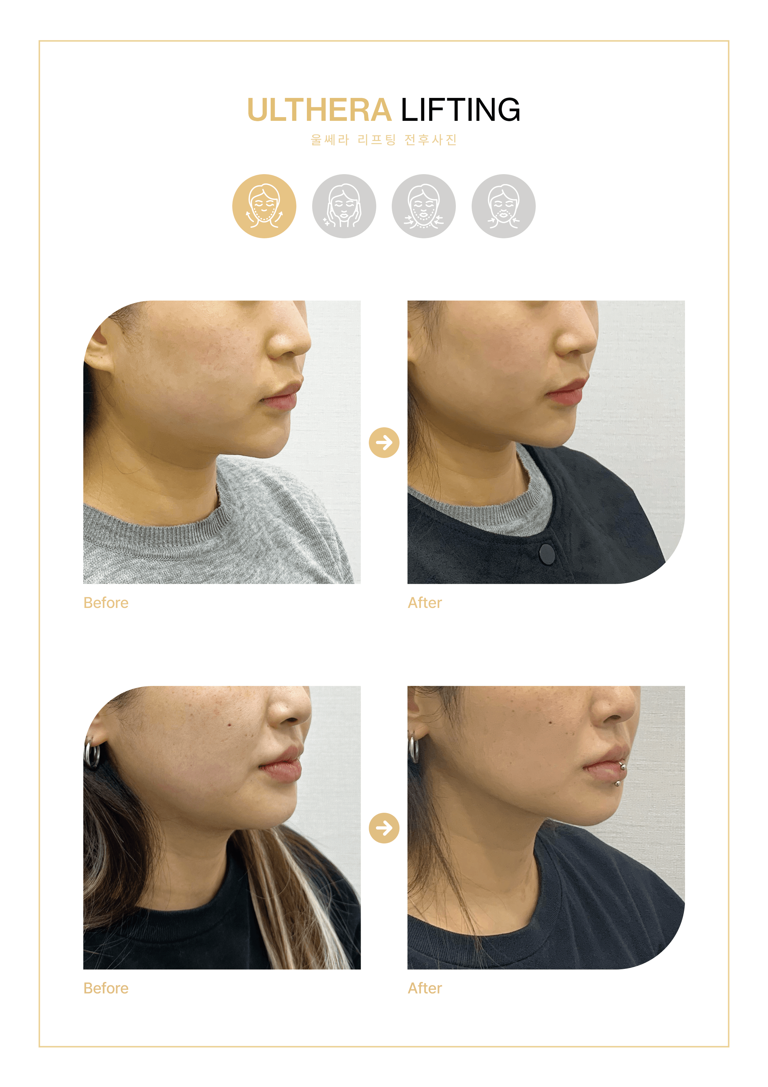 VSLINE CLINIC GANGNAM 案例