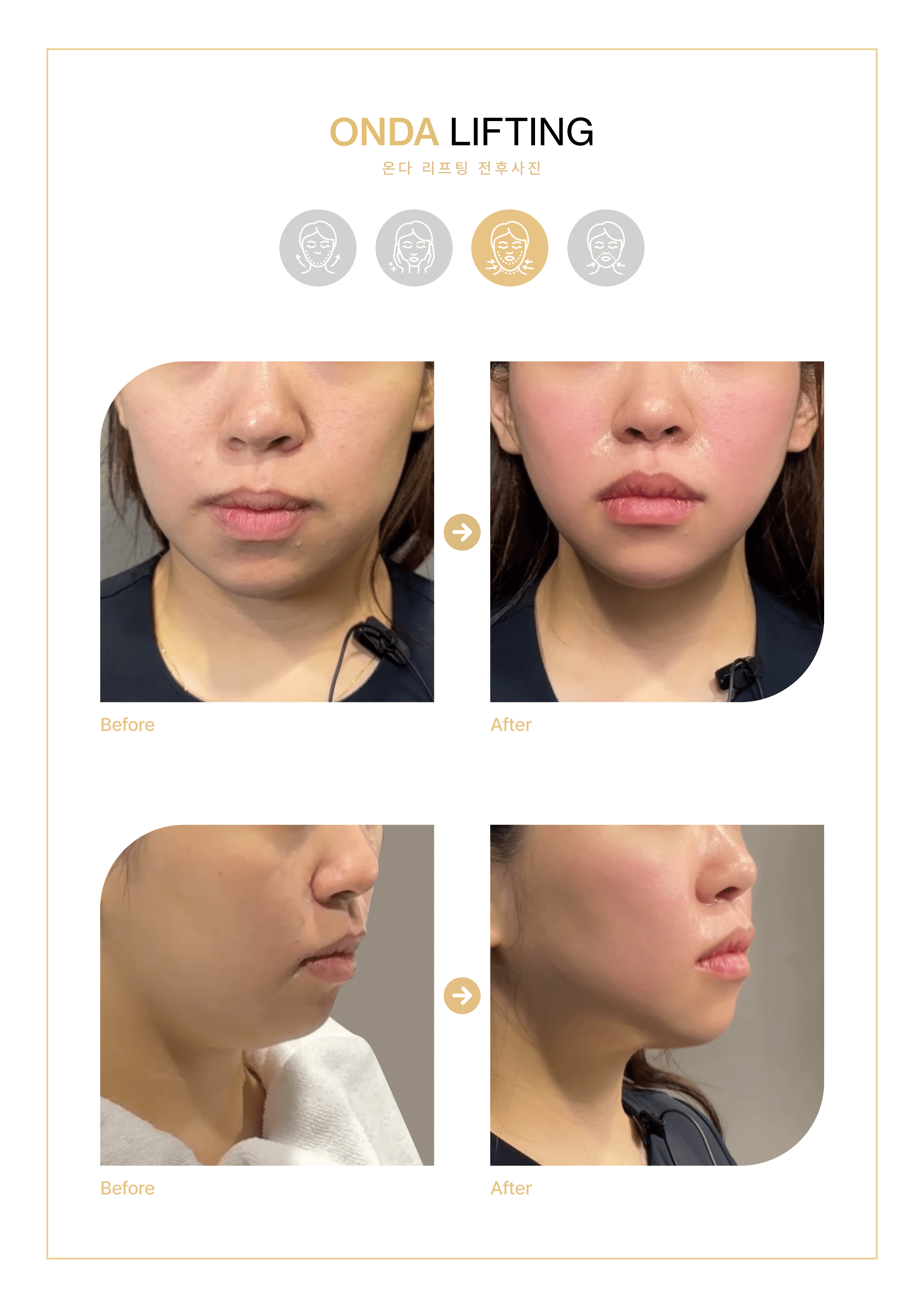 VSLINE CLINIC GANGNAM 案例