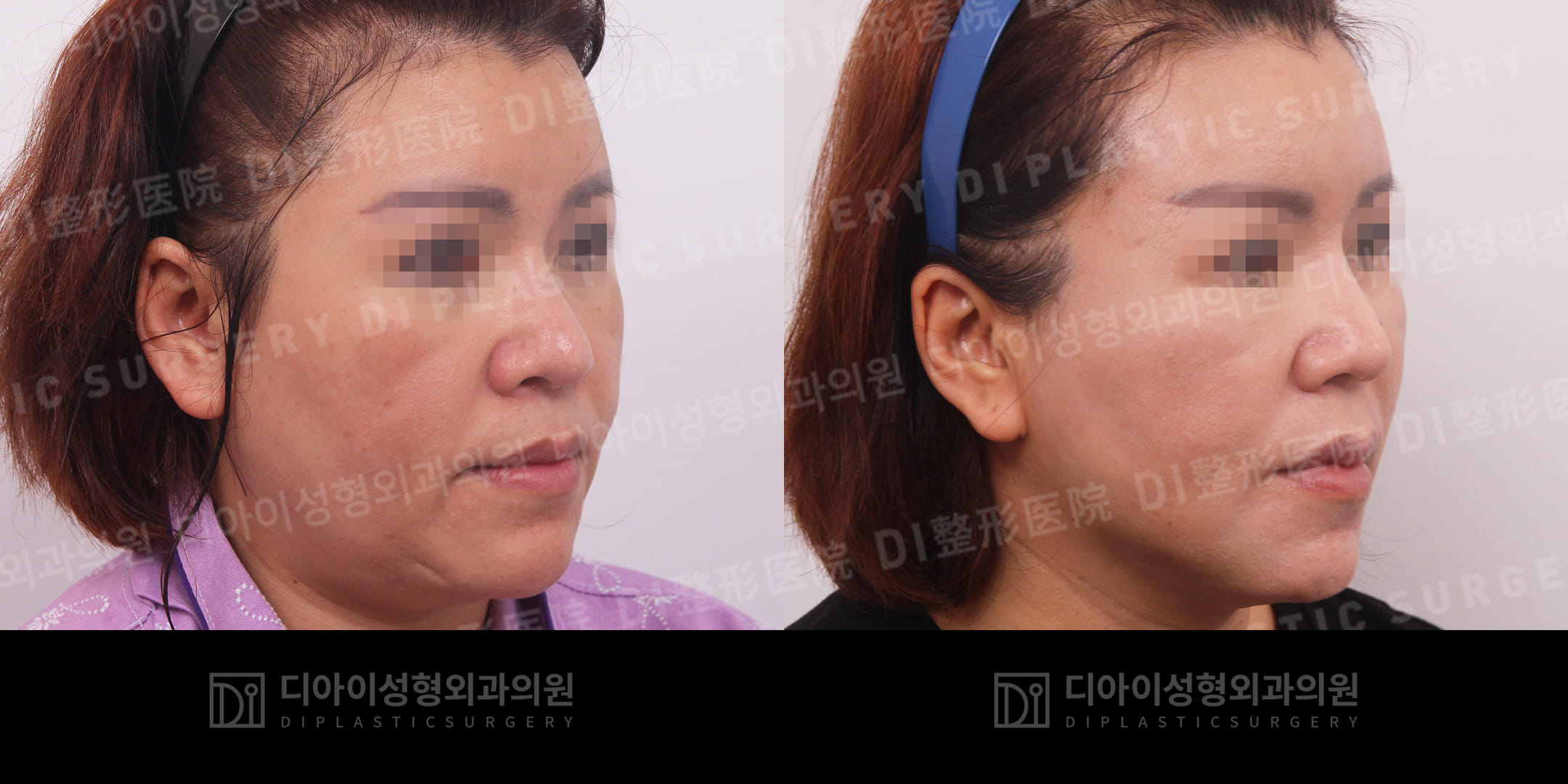 DI PLASTIC SURGERY 案例