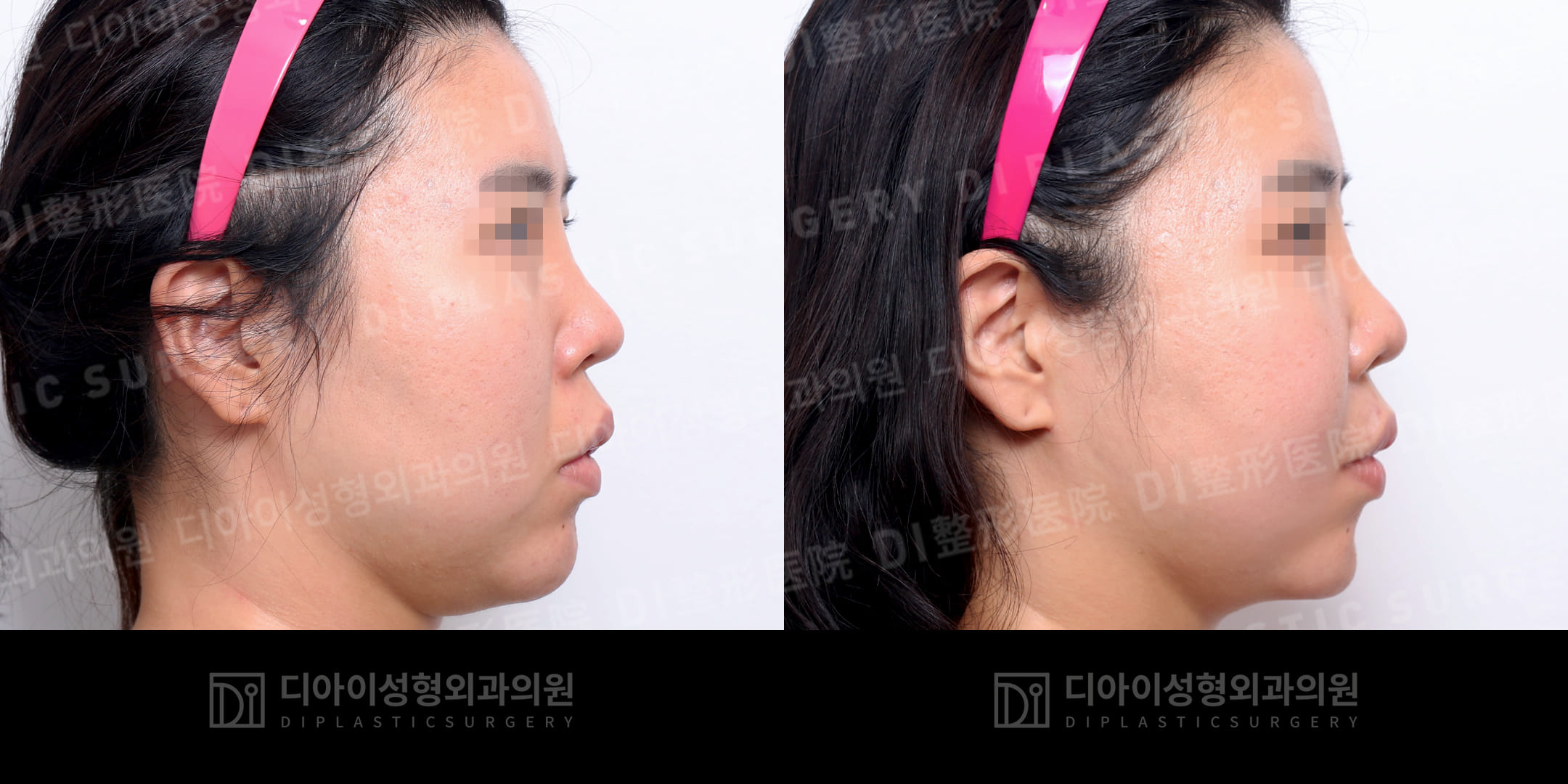 DI PLASTIC SURGERY 案例