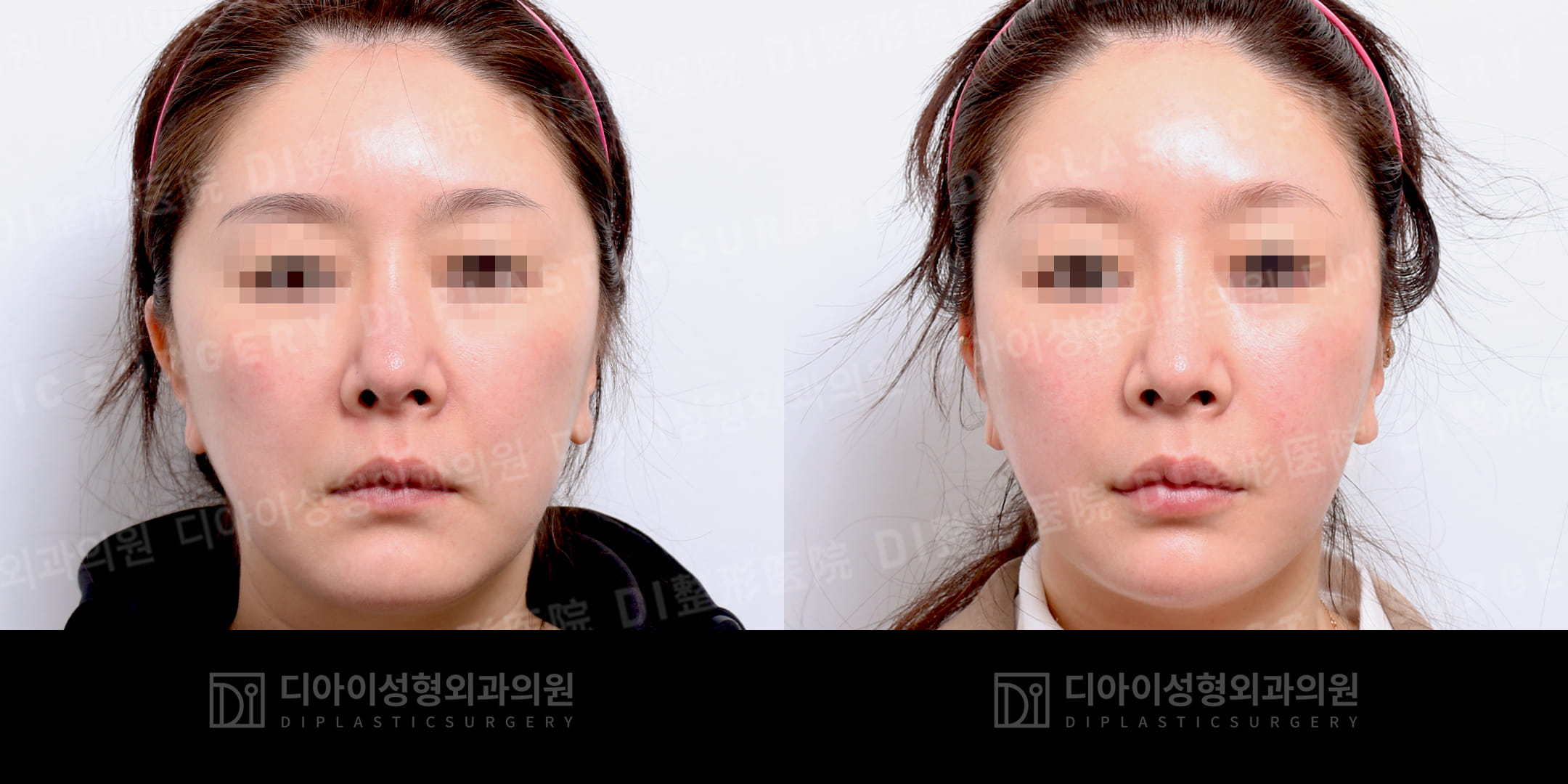 DI PLASTIC SURGERY 案例