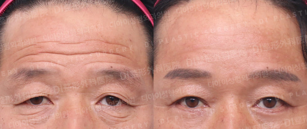 DI PLASTIC SURGERY 案例