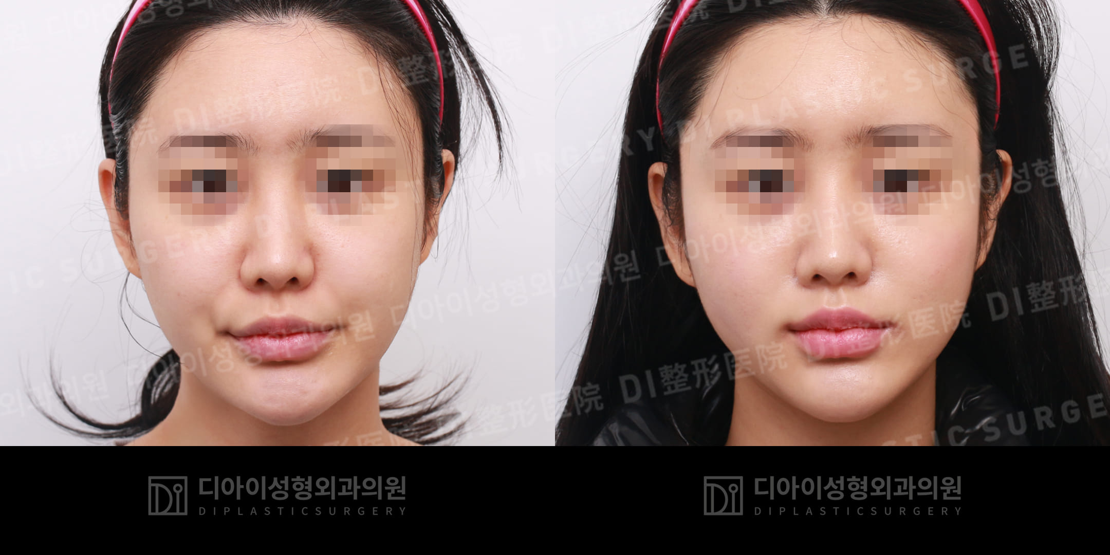 DI PLASTIC SURGERY 案例