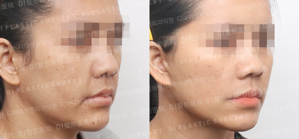 DI PLASTIC SURGERY 案例