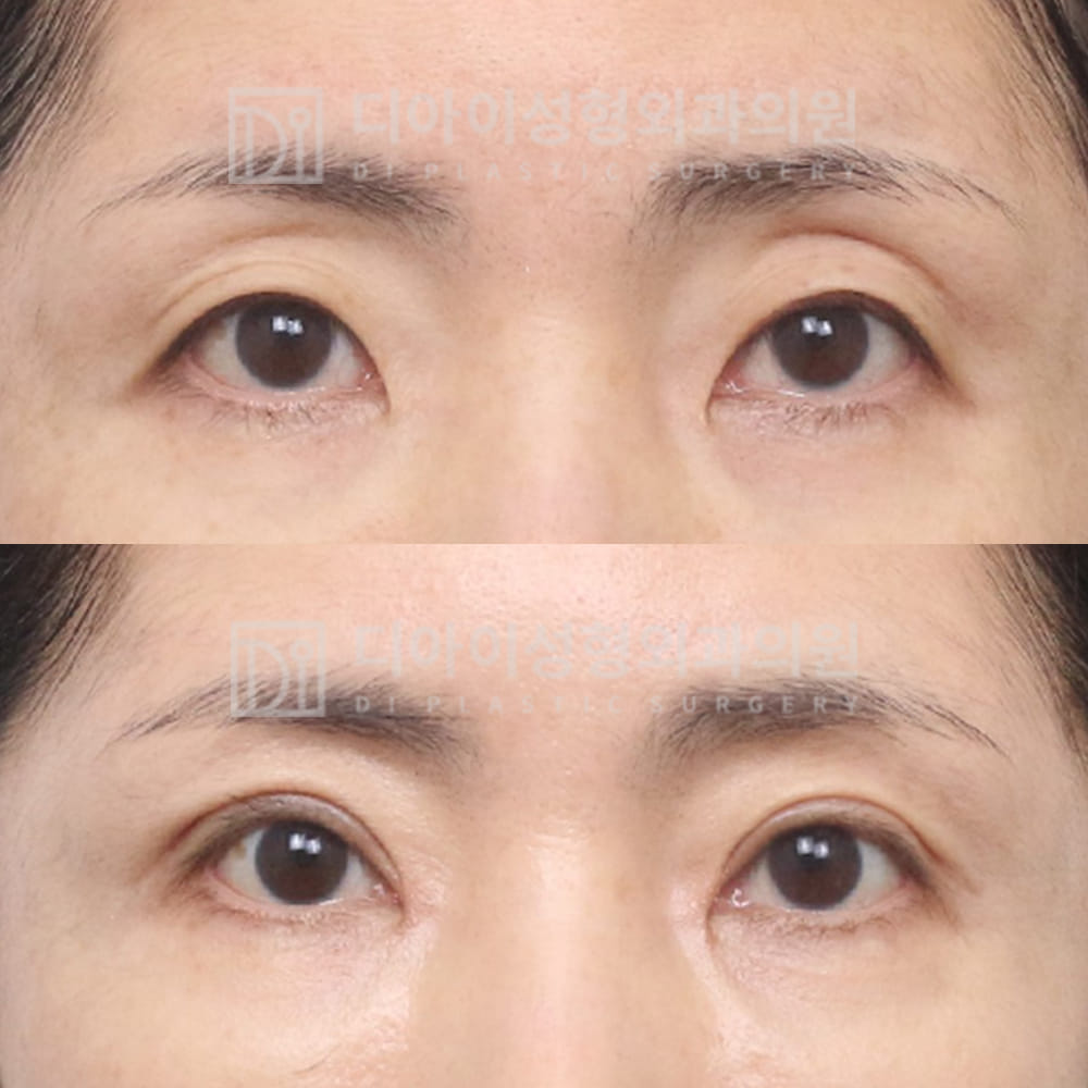 DI PLASTIC SURGERY 案例