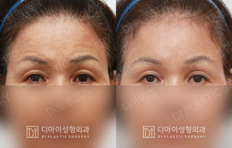 DI PLASTIC SURGERY 案例