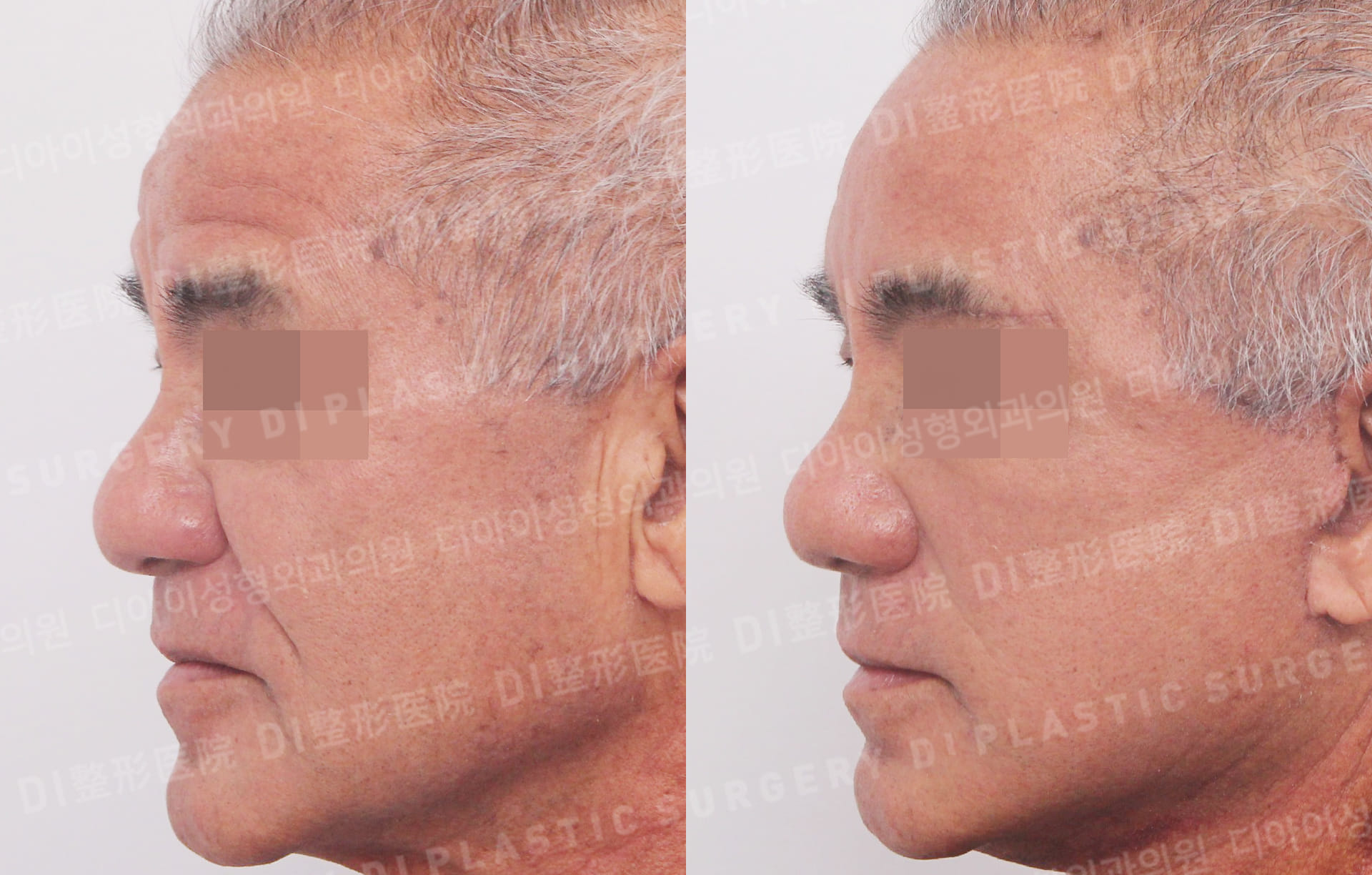 DI PLASTIC SURGERY 案例