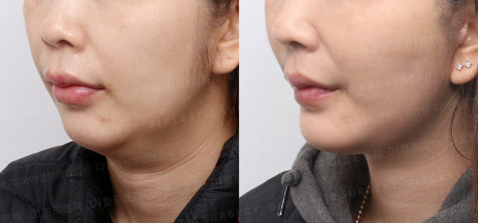 DI PLASTIC SURGERY 案例