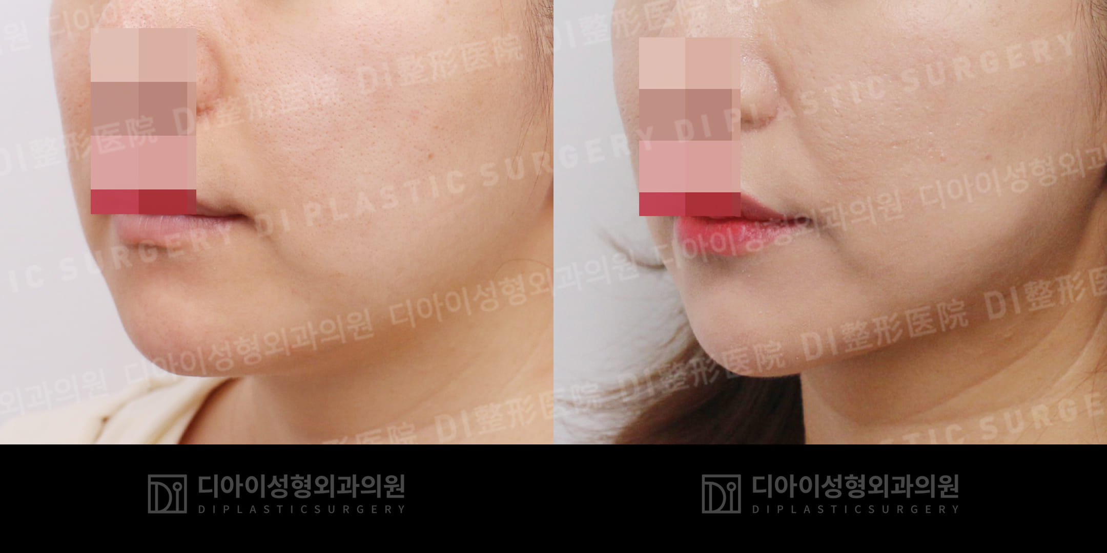 DI PLASTIC SURGERY 案例