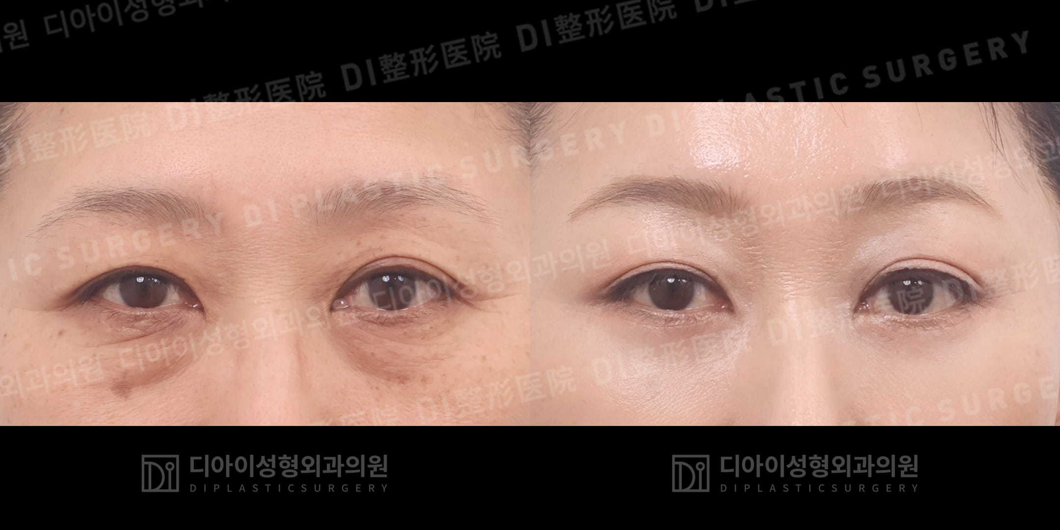 DI PLASTIC SURGERY 案例