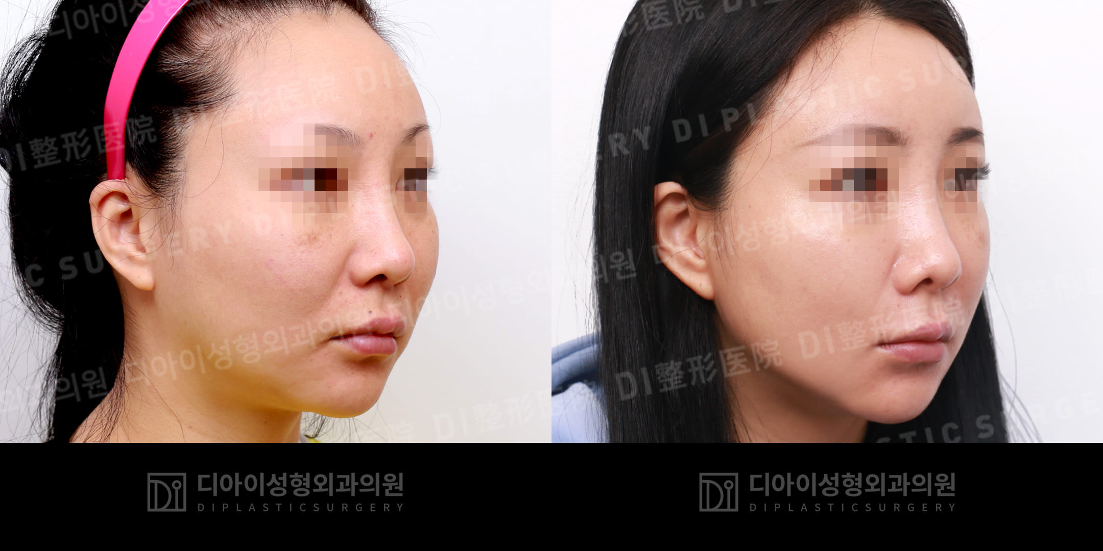 DI PLASTIC SURGERY 案例