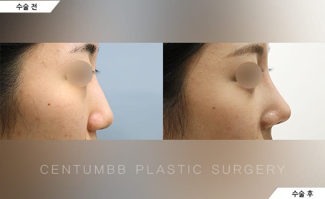 CENTUMBB PLASTIC SURGERY & DERMATOLOGY 案例